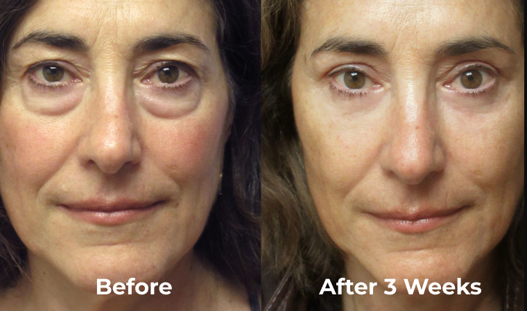 Renewa EyeLift Before After