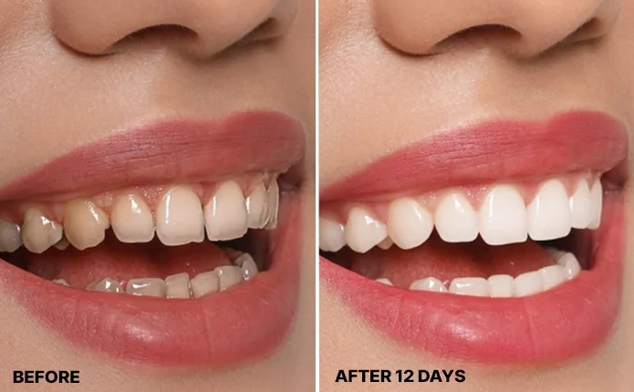 Purely White Deluxe Review 2026: Is This Teeth Whitening Powder Actually Worth It? 6 Purely White Deluxe Before After