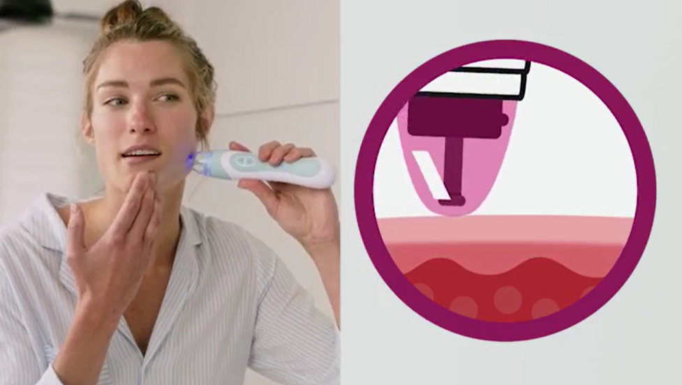 The Ultimate PMD Microderm Review (2026): Real Results, Safety Warnings & Alternatives 5 How To Use PMD MicroDerm
