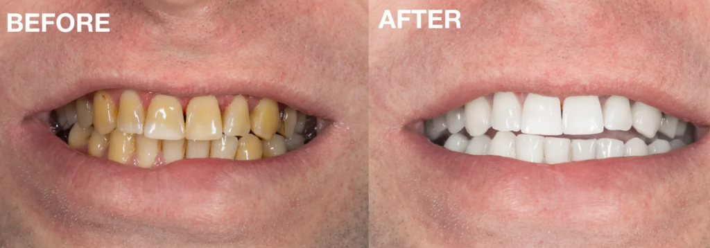 Laughland Teeth Whitening Kit Before & After