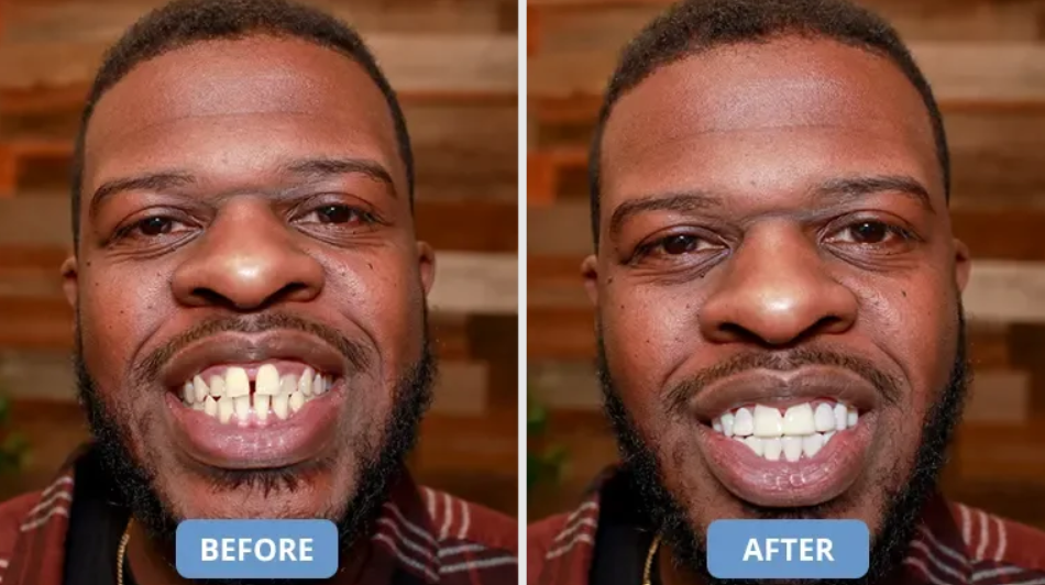 Shiny Smile Veneers Review 2026: Does This Home Cosmetic Solution for Covering Stains, Gaps, and Missing Teeth Actually Work? 8 Shiny Smile Veneers Before & After