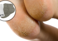 Foot Peel Mask Review 2026: My Honest Experience & Best Picks 17 Foot Peel Mask Review